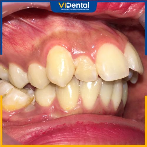 Thông thường các trường hợp răng hô nặng đều do di truyền