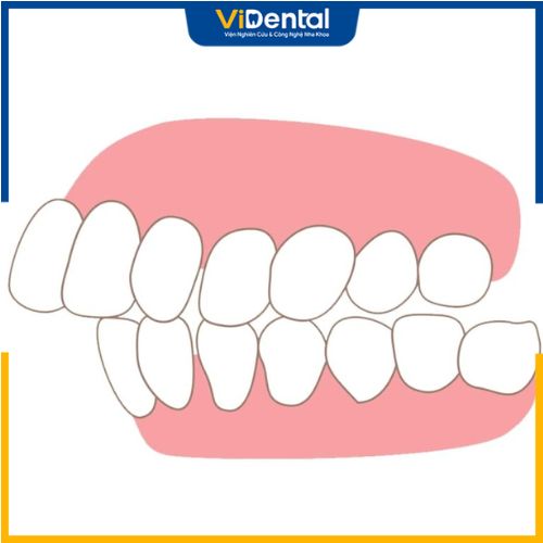 Tình trạng răng hô, đặc biệt là hô, vẩu nặng khá dễ nhận biết