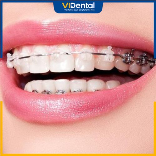 Trường hợp hô do răng đều có thể áp dụng phương pháp niềng răng