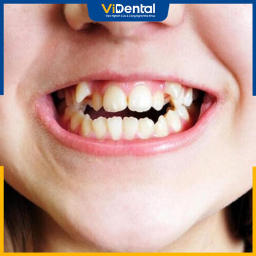 Nhiều tình trạng răng khểnh nặng nên được điều trị