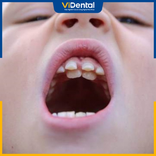 Răng mọc lệch là hiện tượng răng mọc không thẳng hàng