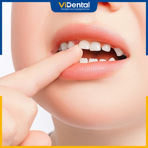 Tình trạng răng mọc không đều có thể do di truyền