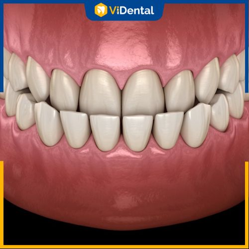 Răng móm dùng để chỉ tình trạng một người có răng hàm dưới đưa ra trước so với hàm trên