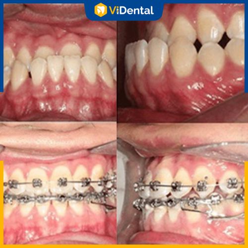 Phương pháp niềng răng - chỉnh nha phù hợp với mọi tình trạng móm răng