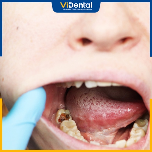 Tình trạng sâu răng phổ biến ở mọi lứa tuổi