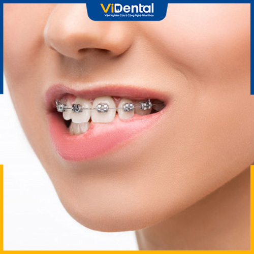 Niềng răng là biện pháp cải thiện răng thưa được lựa chọn nhiều