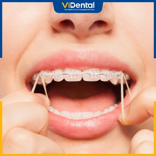 Các loại thun niềng răng có chức năng hỗ trợ quá trình điều trị chỉnh nha