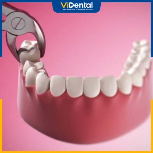Số lượng răng cần nhổ sẽ phụ thuộc vào tình trạng răng và phương pháp niềng