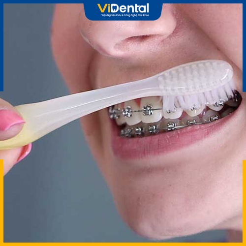 Việc chăm sóc răng miệng không đúng cách gây tổn thương răng, thậm chí làm hỏng khí cụ niềng