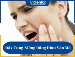 Dây cung niềng răng đâm vào má là vấn đề thường xuyên xảy ra trong quá trình chỉnh nha thẩm mỹ