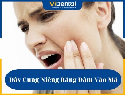 Dây cung niềng răng đâm vào má là vấn đề thường xuyên xảy ra trong quá trình chỉnh nha thẩm mỹ