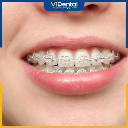 Theo các chuyên gia, giai đoạn xấu nhất khi niềng răng rơi vào khoảng 3 tháng đầu tiên