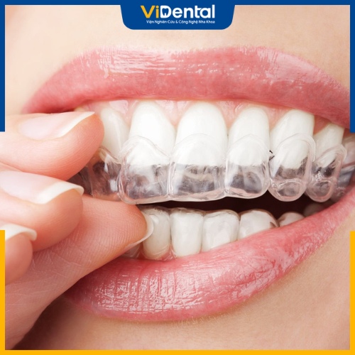 Để khắc phục giai đoạn xấu nhất khi niềng răng, bạn có thể sử dụng phương pháp niềng răng bằng khay trong suốt