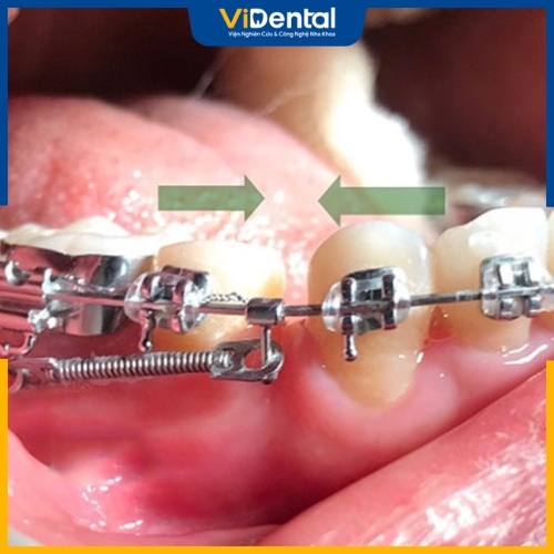 Đóng khoảng là kỹ thuật sắp xếp các răng về vị trí chuẩn trên cung hàm bằng các dụng cụ chuyên khoa