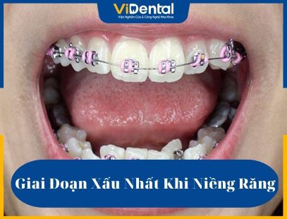 Giai đoạn xấu nhất khi niềng răng được nhiều khách hàng quan tâm khi có nhu cầu chỉnh nha