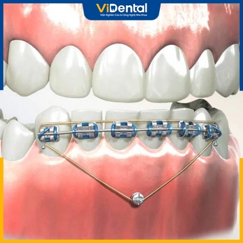 Phương pháp sử dụng minivis cụm răng hàm