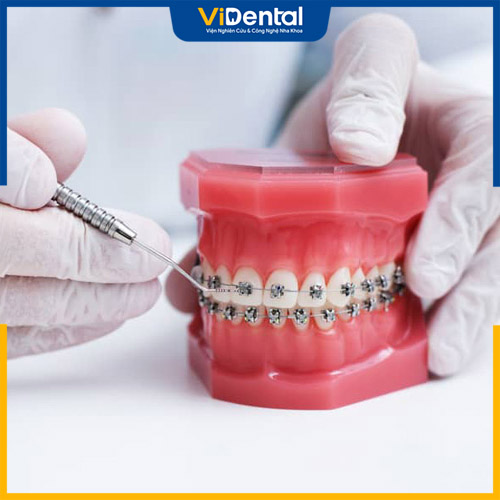 Khí cụ chỉnh nha là thiết bị dùng trong niềng răng