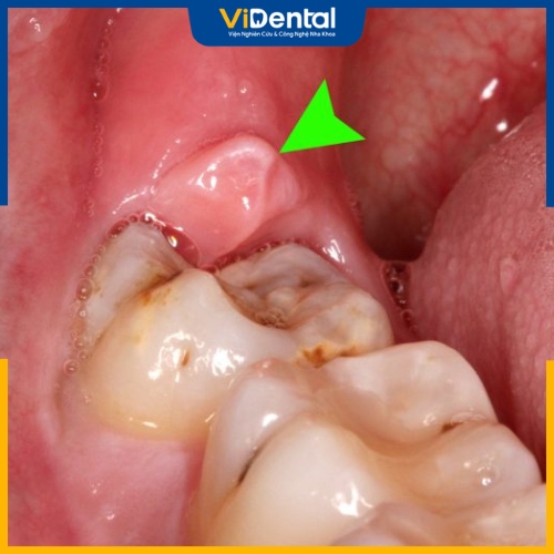 Lợi trùm là một loại bệnh lý liên quan đến quá trình phát triển của răng khôn