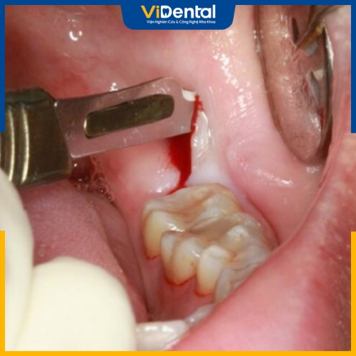 Tình trạng lợi trùm khi niềng răng cần được phát hiện sớm và điều trị kịp thời