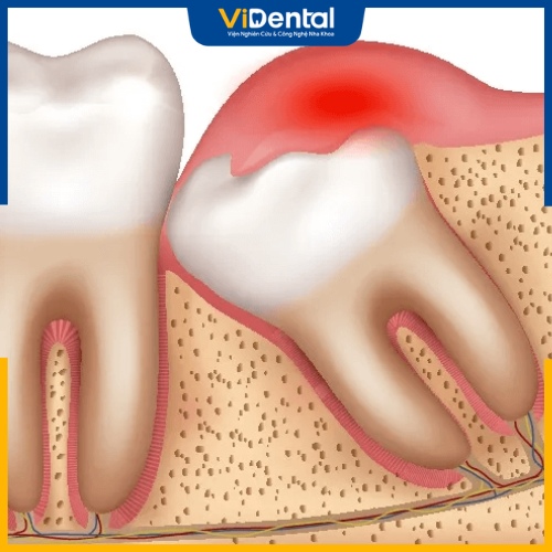 Đây là nguyên nhân phổ biến khiến lợi trùm xuất hiện trong khi niềng răng
