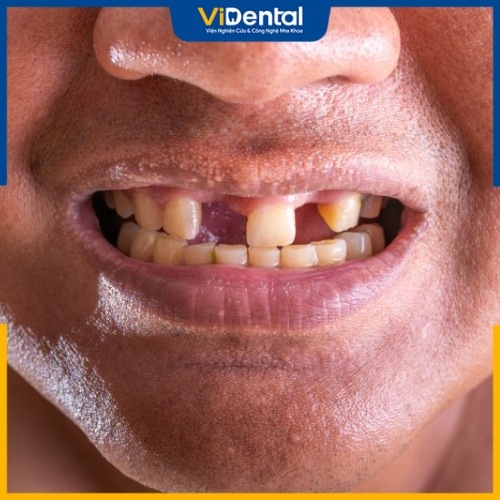 Trường hợp mất nhiều răng hoặc có tiền sử bệnh tới sức khỏe không thể thực hiện niềng