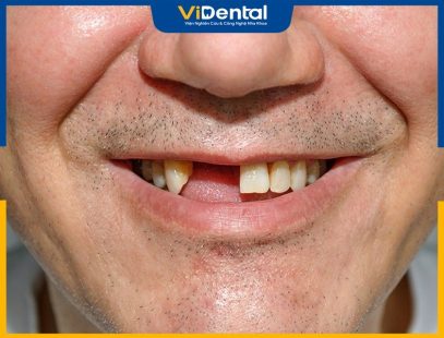 Chuyên Gia Giải Đáp: Mất Răng Có Niềng Răng Được Không?