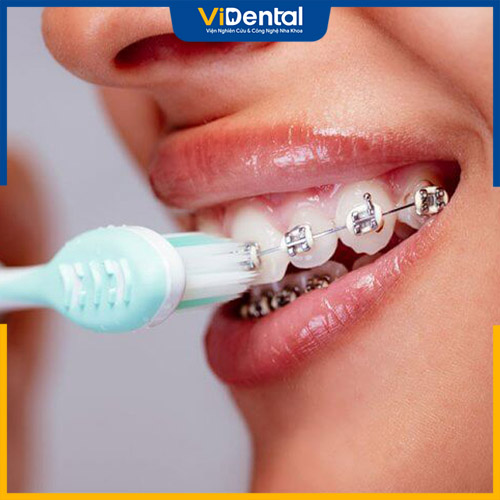Giai đoạn đầu khi chỉnh nha bạn sẽ khó khăn khi vệ sinh răng miệng