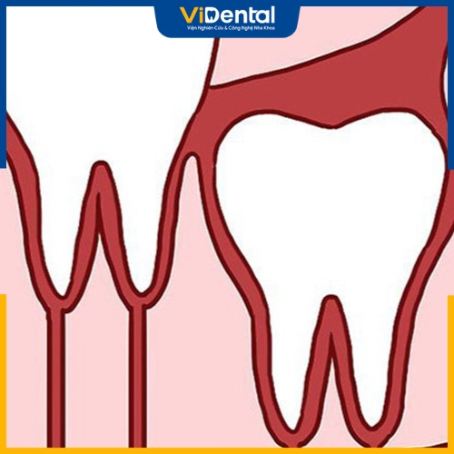 Điều kiện để niềng kéo răng khôn là răng số 8 mọc thẳng hoặc mức độ nghiêng ít và có mô nha chu khỏe mạnh
