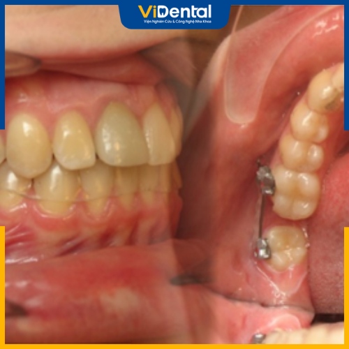 Niềng kéo răng khôn là kỹ thuật kéo răng số 8 thay thế vị trí răng hàm đã mất