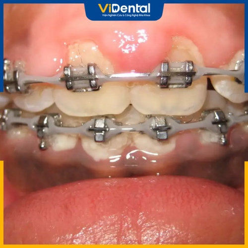 Tình trạng niềng răng bị sưng lợi có thể xuất hiện do răng chịu lực tác động quá mạnh của hệ thống khí cụ