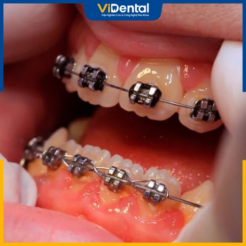 Niềng răng bị sưng lợi là một báo hiệu xấu cho sức khỏe răng miệng