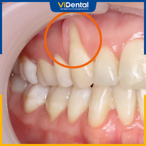 Tụt lợi là hiện tượng lợi di chuyển vào sâu bên trong chân răng hoặc mất dần