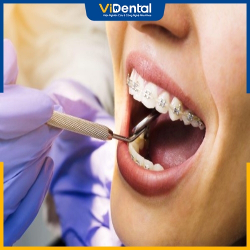 Niềng răng làm cho răng dịch chuyển mà không ảnh hưởng đến thần kinh