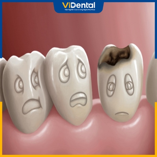Mất canxi răng là vi khuẩn làm mất đi các khoáng chất tự nhiên trên men răng