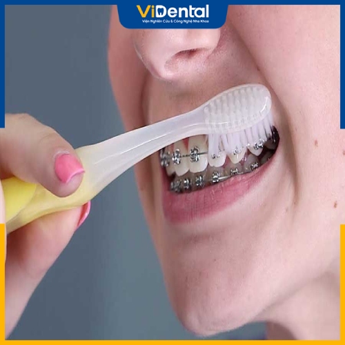 Vệ sinh răng miệng và nẹp răng sạch sẽ là điều vô cùng quan trọng
