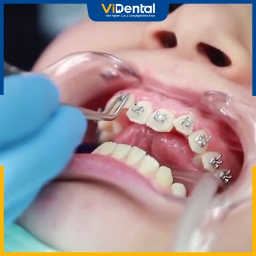 Trong trường hợp niềng răng sai cách, vị trí mắc cài không khớp với răng khiến răng di chuyển không đúng lộ trình ban đầu