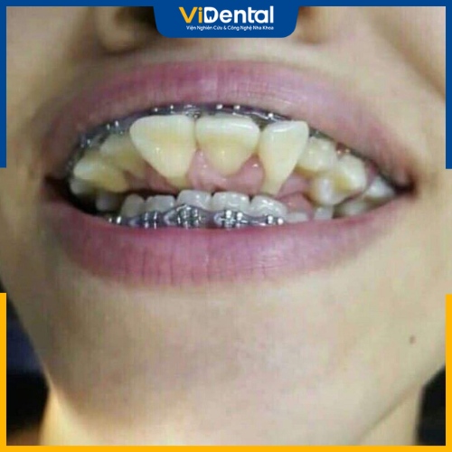 Niềng răng hỏng có thể gây tổn thương răng bởi