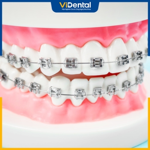 Dây cung niềng răng là khí cụ không thể thiếu trong điều trị niềng răng