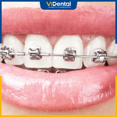 Niềng răng sứ bằng mắc cài kim loại giúp tối ưu thời gian và tiết kiệm chi phí