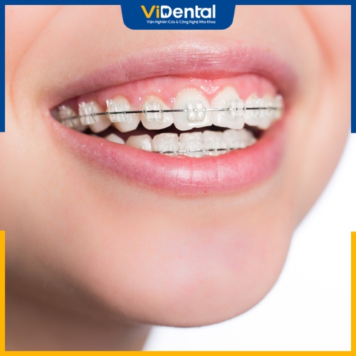 Niềng răng bằng mắc cài sứ đảm bảo tính thẩm mỹ hơn so với mắc cài kim loại 
