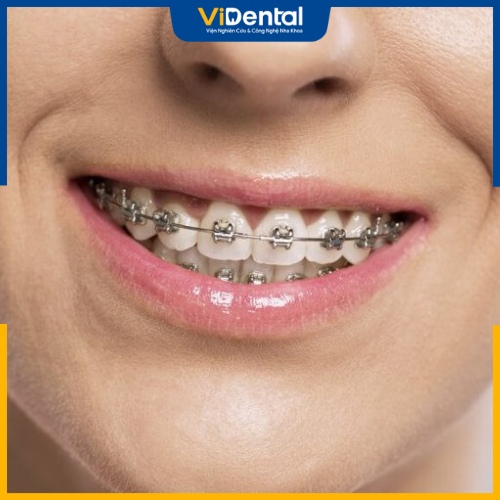 Trong trường hợp chỉ bọc răng sứ một hoặc một vài chiếc răng kèm theo tình trạng sai lệch khớp cắn nghiêm trọng thì nên niềng răng