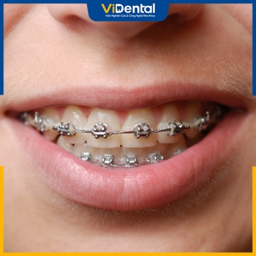 Niềng răng giúp khắc phục một số vấn đề răng miệng hiệu quả