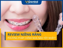 Review Niềng Răng: Phương Pháp Điều Trị Nào Tốt Nhất