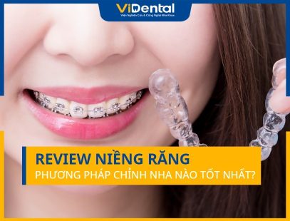 Review Niềng Răng: Phương Pháp Điều Trị Nào Tốt Nhất