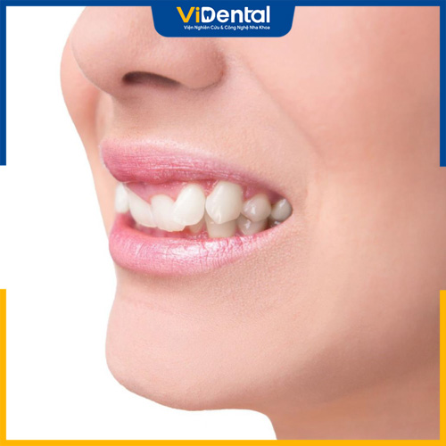 Một số trường hợp tháo niềng răng sớm răng bị khấp khểnh, không đều