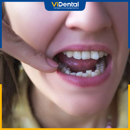 Nếu chăm sóc không đúng cách, răng có thể chạy lại vị trí cũ