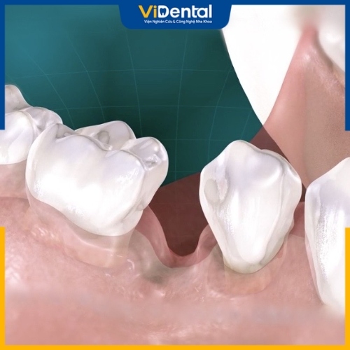 Tiêu xương là tình trạng suy giảm xương phần ổ răng và khu vực xương xung quanh chân răng