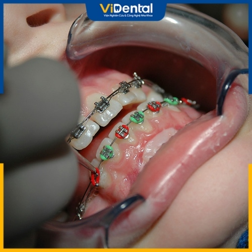 Niềng răng khi bị tiêu xương hàm được không phụ thuộc tình trạng xương