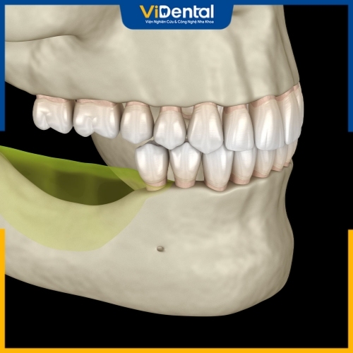 Phục hồi tình trạng xương hàm bằng ghép xương hoặc nâng xoang hàm