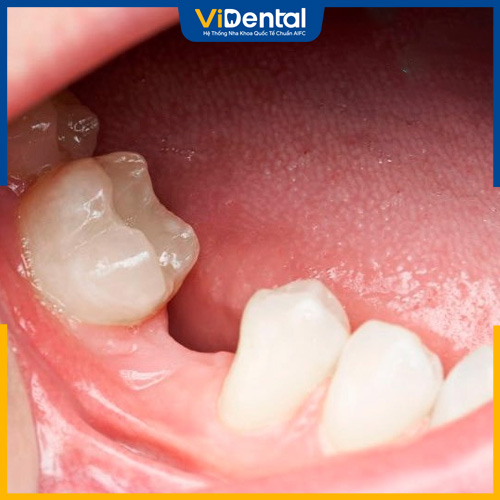 Niềng răng ở nha khoa không uy tín gây mất răng